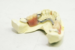 partial-crhome-denture