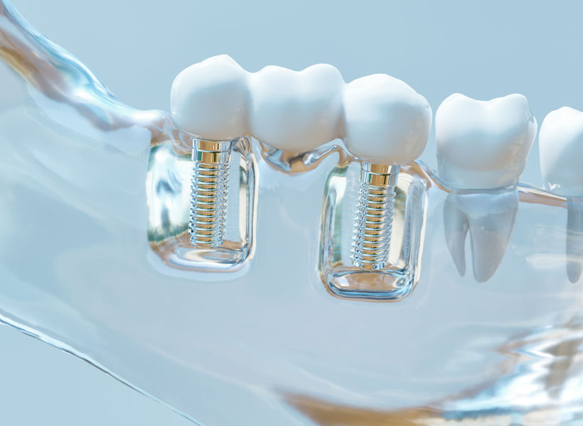 Dental Implants Gold Coast