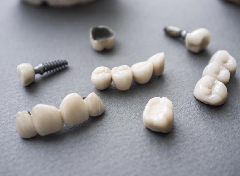 Dental Implant Laboratory Dental Implant Lab Dental Lab Gold Coast